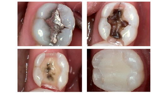 Dental crowns vs. Dental Fillings