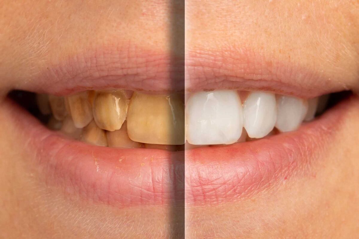 Can Yellow Teeth Become White Again? - Beverly Heights Dental