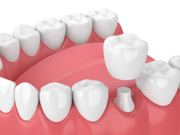 cosmetic benefits of dental crowns